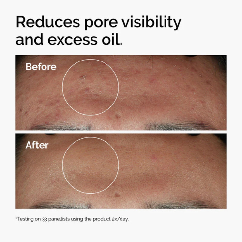 The Ordinary - Niacinamide 10% + Zinc 1% (30ml)