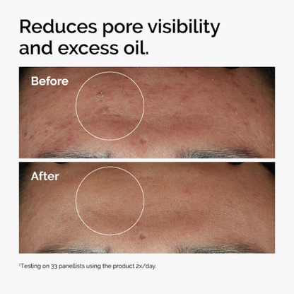 The Ordinary - Niacinamide 10% + Zinc 1% (30ml)